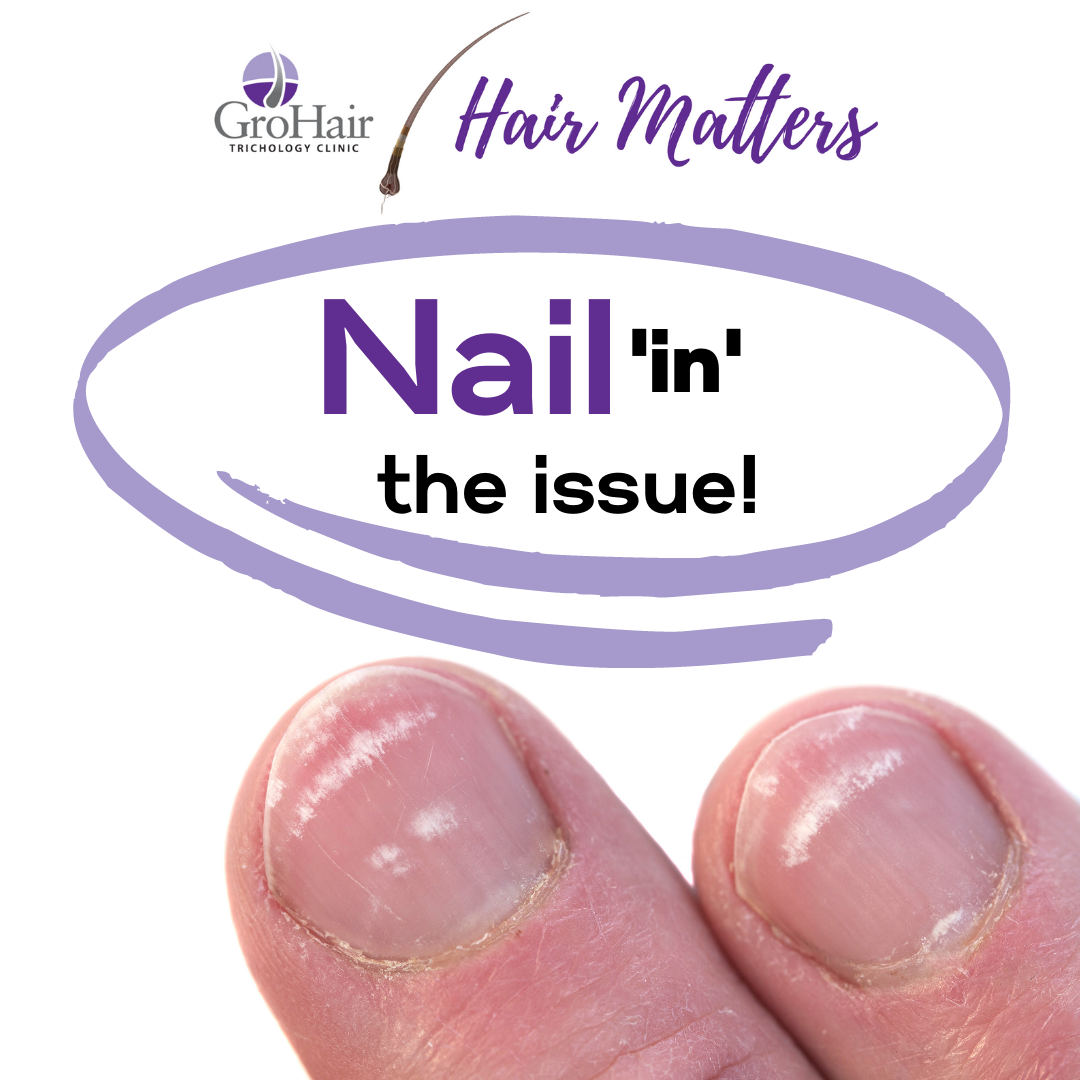 Nail'in' the Issue - GroHair Trichology Clinic
